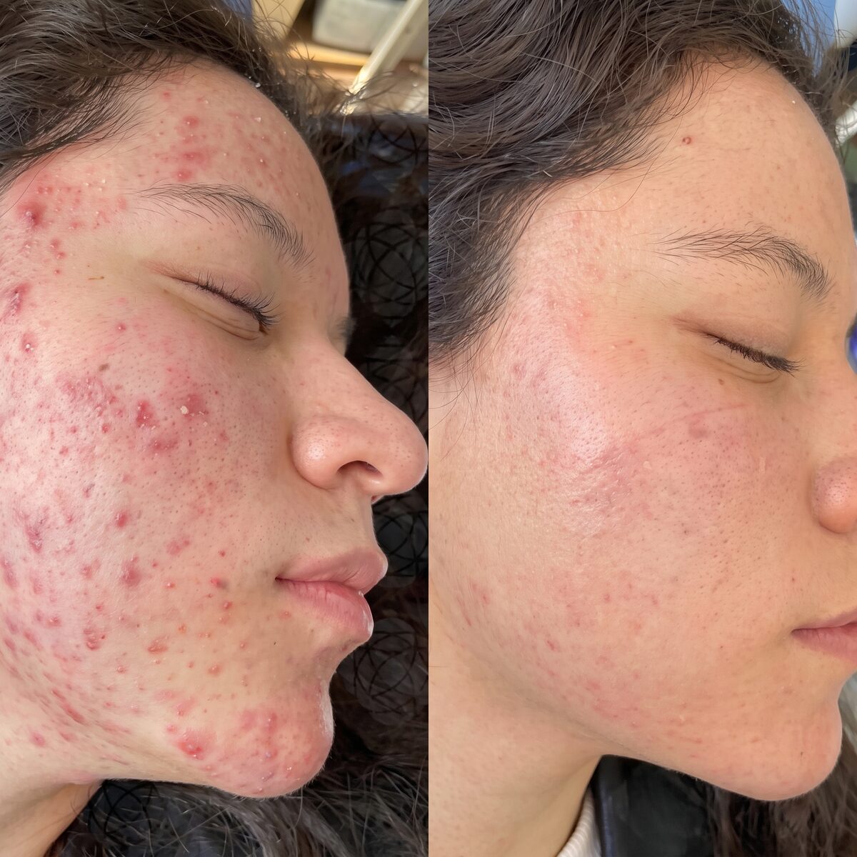Antes y después rostro