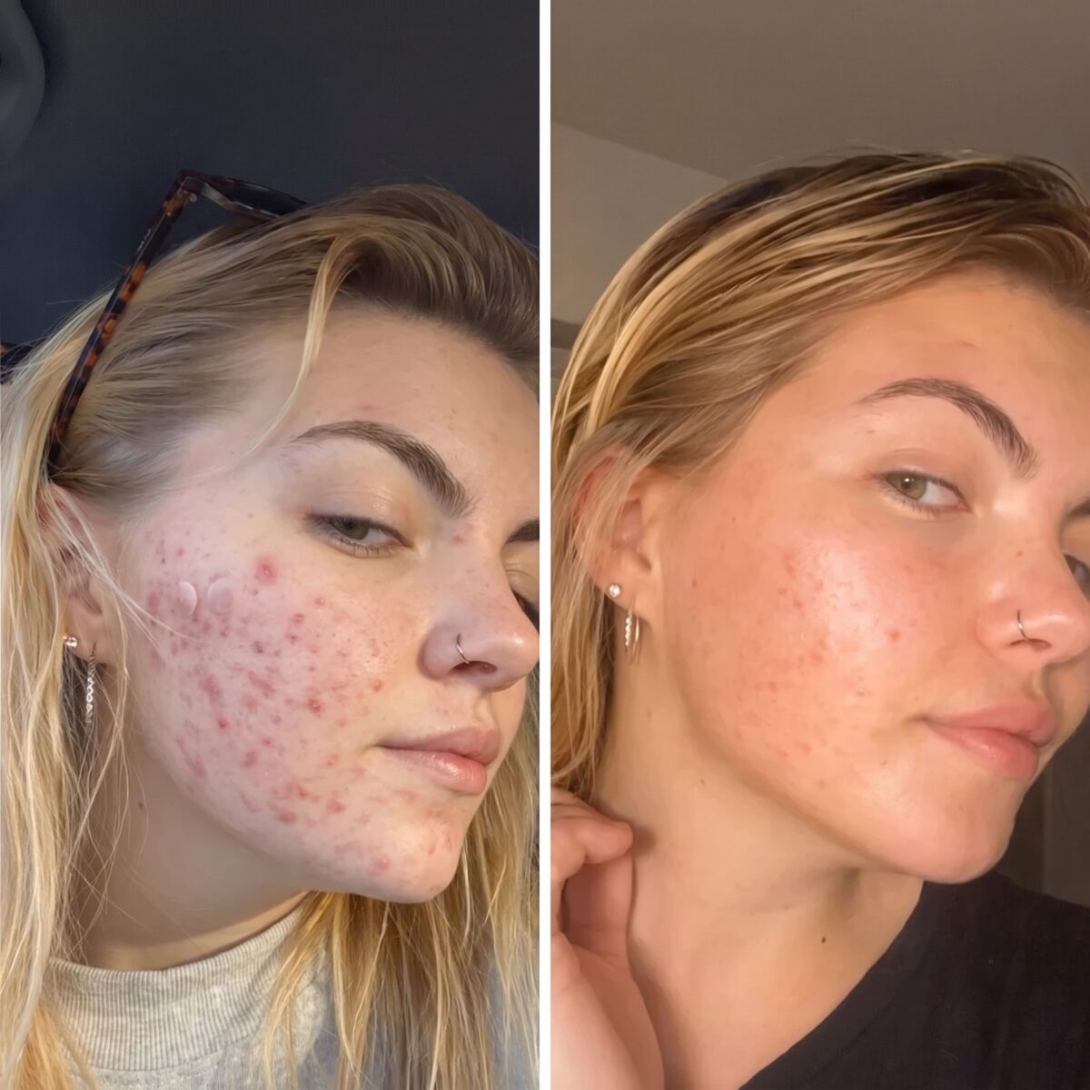 Antes y después rostro