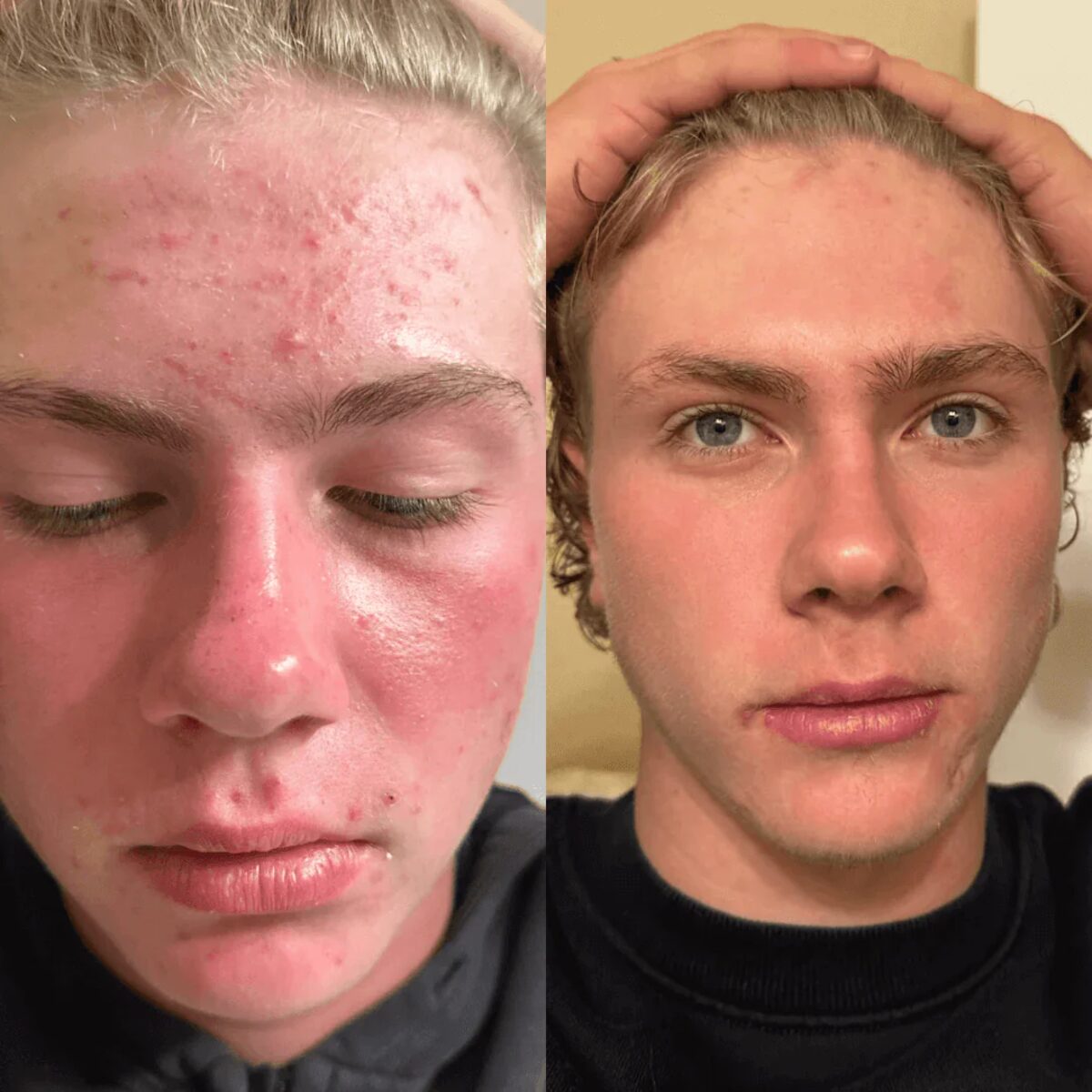 Antes y después frente