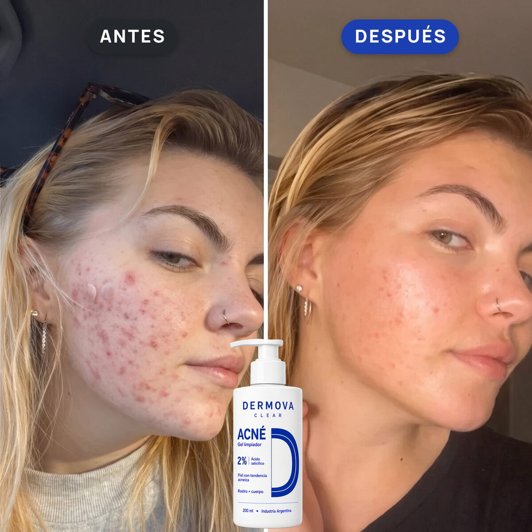 Antes y después: acné en la mejilla