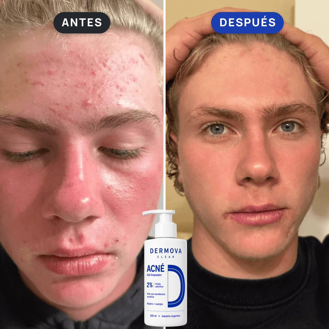 Antes y después: acné en la cara de un adolescente